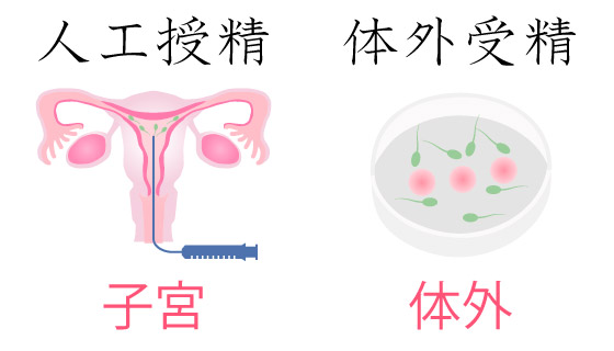 人工授精と体外受精のイメージ画像